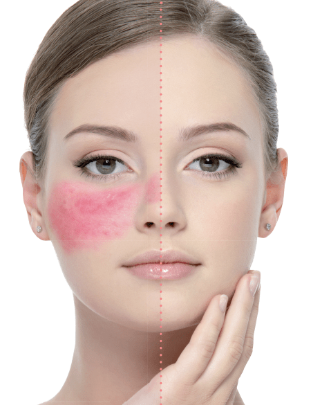 Rosacea What is Rosacea? How to treat Rosacea? By Lizzy Winship